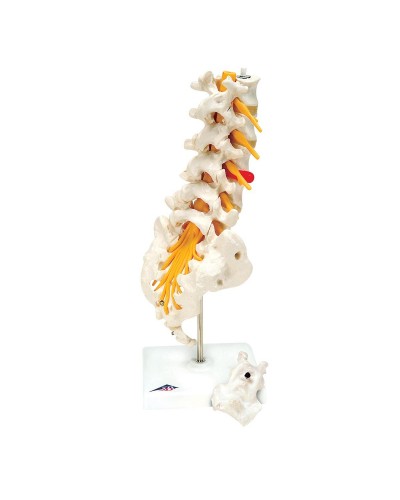 Lumbar Spinal Column with Dorso-Lateral Prolapsed Intervertebral Disc